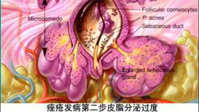 痤疮的发病机理