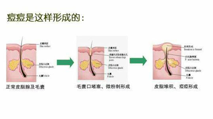青春痘的治疗