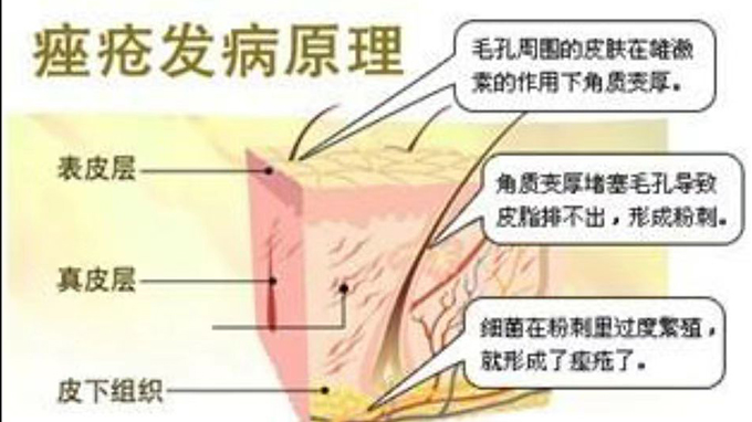 青春痘是怎样形成的