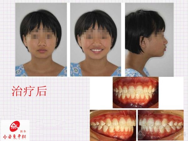 2014-10-九月份正畸病例展示-安氏三类错合（非拔牙矫治）