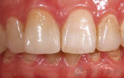 2015-10-八月份病历展示：种植科前牙种植修复