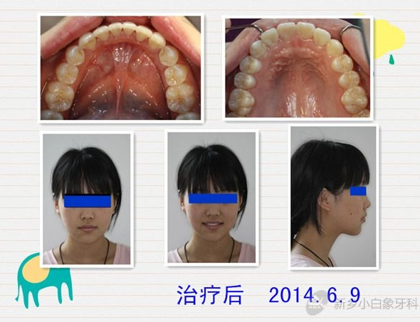 2014-07-马某某安氏一类错合非拔牙矫治展示