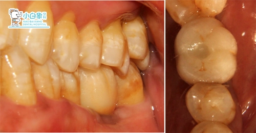 2018-11月种植修复病例