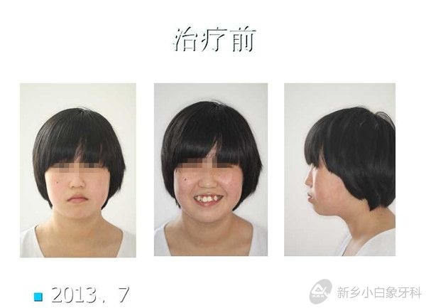 八月份病历展示：正畸科安氏一类错合拔牙矫治