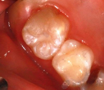 十一月病历展示：深龋护充