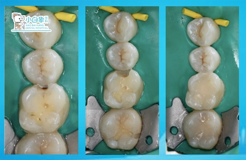 2019-6月充填病例