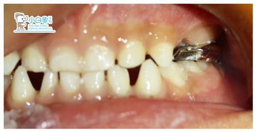 2月儿童牙病例