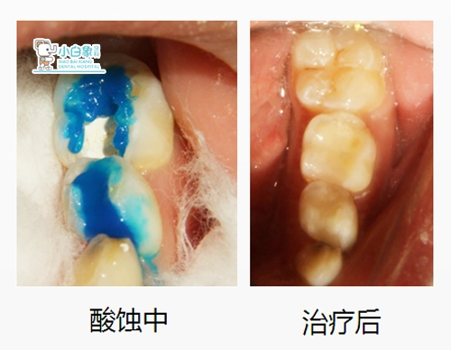 2019-1月补牙病例