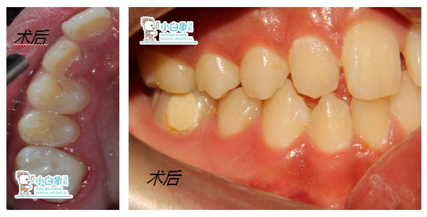 2019-8月树脂充填病例
