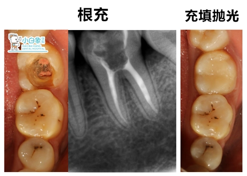 2018-10月补牙病例