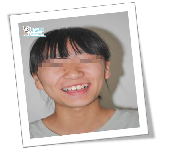 正畸六月份病例----骨性三类错合/拔除第一恒磨牙