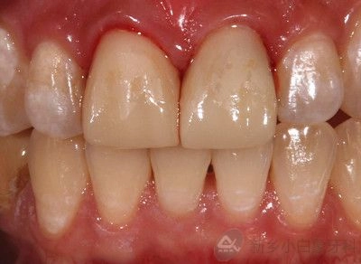 修复科六月份病历展示：11.21瓷睿刻全冠修复