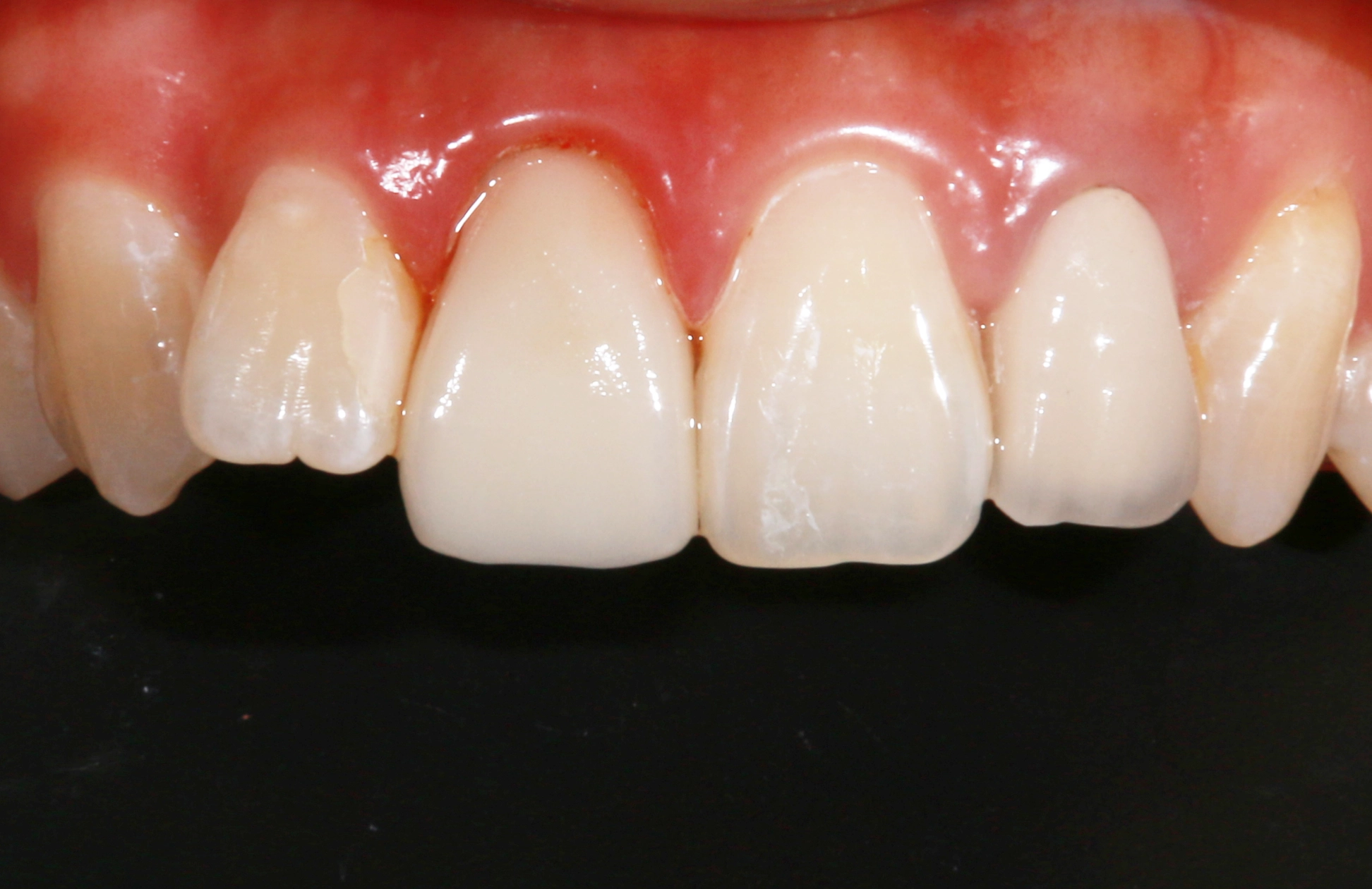 修复科五月份病历展示：11瓷睿刻全冠修复