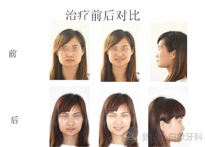 2015-07-正畸科六月份病历展示：安氏二类错颌