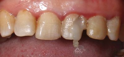 十一月病历展示：全瓷冠修复