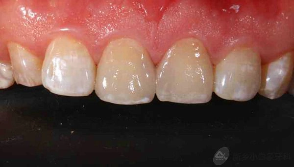 九月份病例展示：11瓷睿刻全冠修复