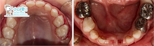 9月儿牙舒眠治疗病例
