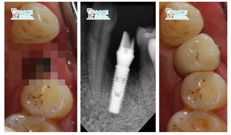2018-04-种植修复