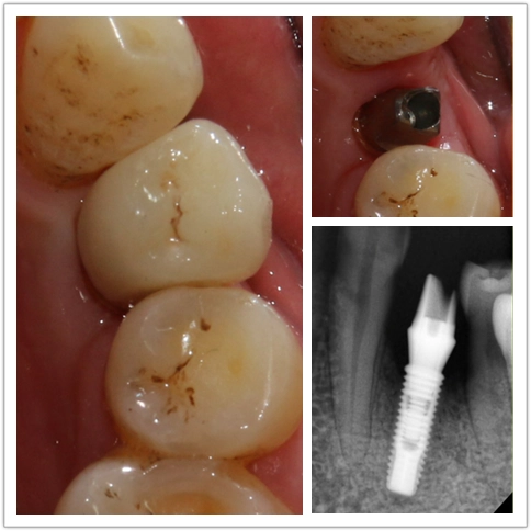 2017-09-八月份种植病例
