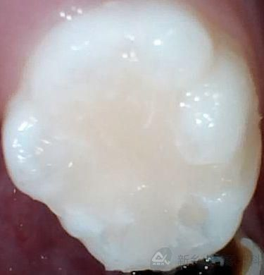 二月份病例展示——深龋护充