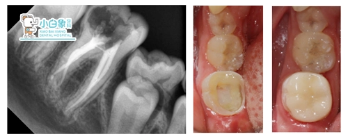 2018-8月根管治疗病例