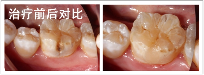 八月份补牙病例