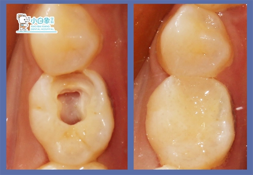 7月根管治疗病例