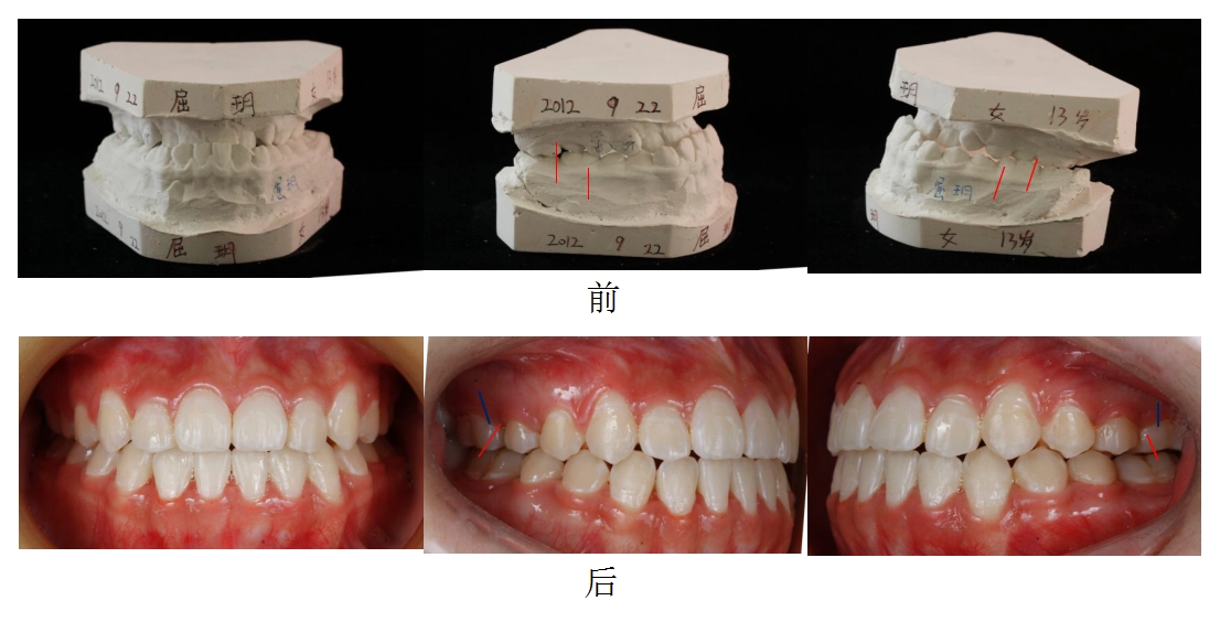 2017-10-安氏三类错合-非拔牙矫治