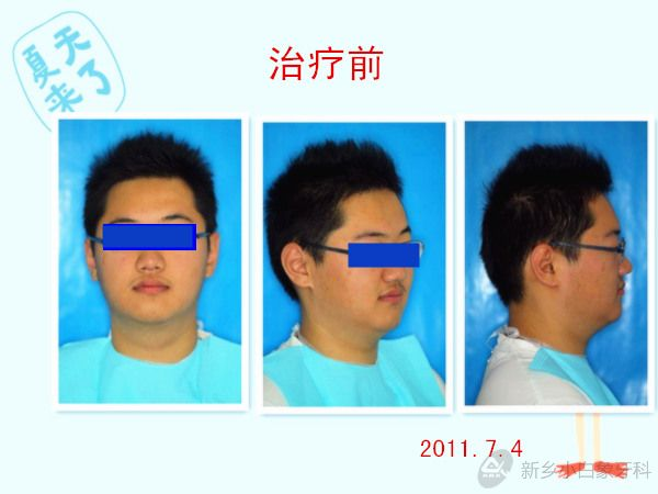 2014-06-六月份一例正畸展示