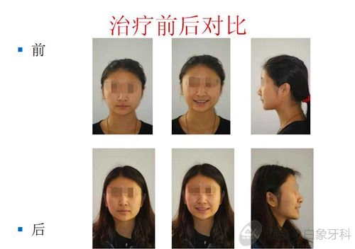 二月份病例展示——安氏二类错颌非拔牙矫治