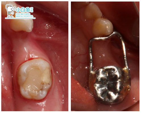 十一月儿童牙科病例