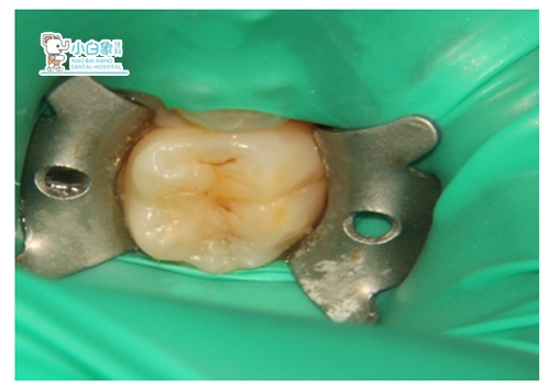 2018-12月充填病例