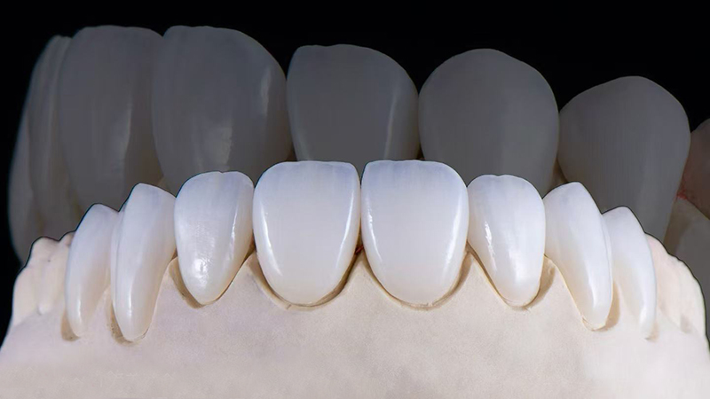Full arch Zirconia implant bridge