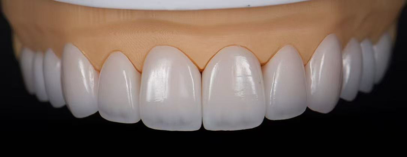 Screwed Retained Full Arch Implant bridge case