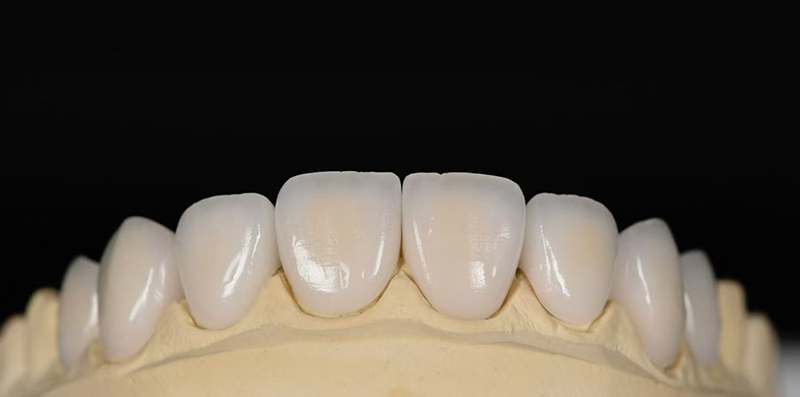 Non-prep emax veneer