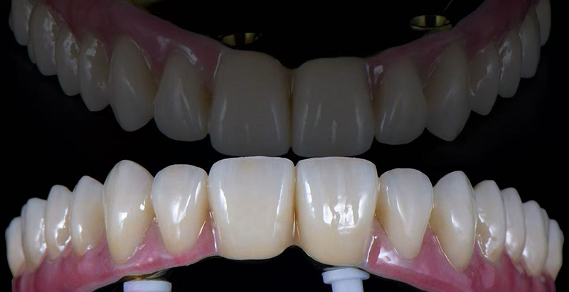 Individualized full arch implant bridge