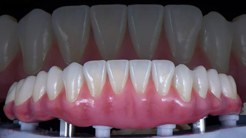 Natural Look Emax Crown